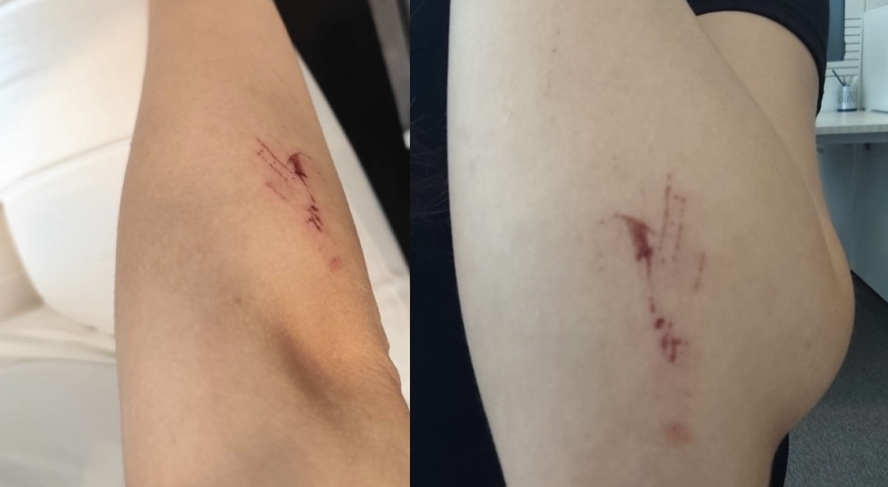 Aggredita da una straniera a calci, sputi e graffi: il racconto di una giovane