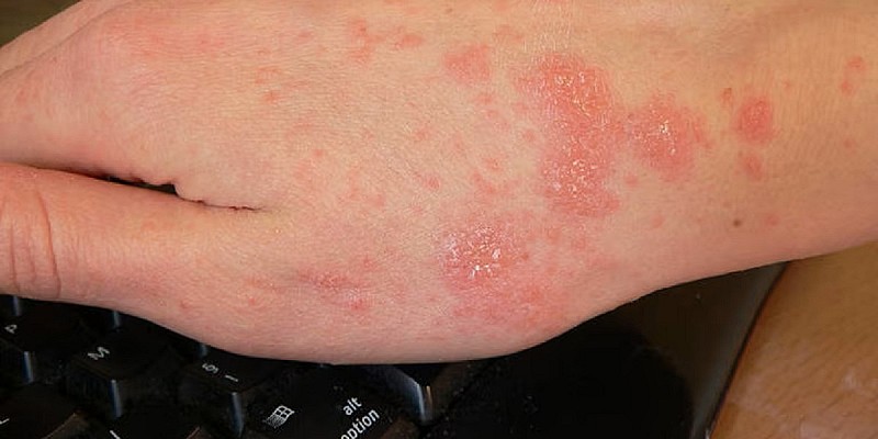 E’ allarme scabbia in Italia: casi aumentati del 750% in 3 anni